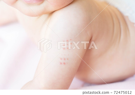 接種嬰兒的手臂狀態 接種嬰兒的手臂狀態 72475012