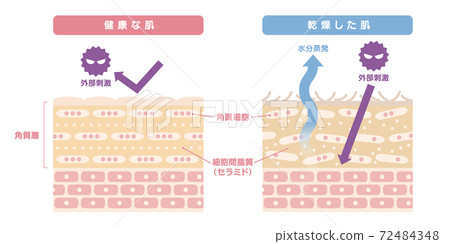 Cross-sections and illustrations of skin comparing healthy and dry skin Cross-sections and illustrations of skin comparing healthy and dry skin 72484348