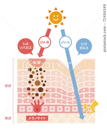 紫外線造成的皮膚損傷 色斑和皺紋 插圖素材 圖庫