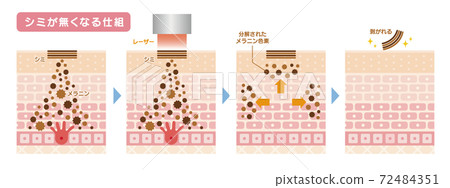 皮膚斑點治療激光治療 72484351