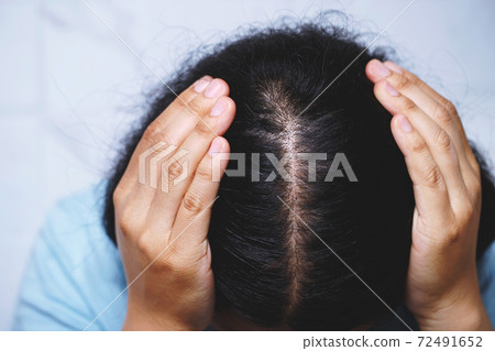 A woman with hair loss, she's allergic to shampoo and conditioner. 72491652