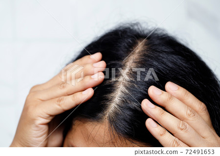 A woman with hair loss, she's allergic to shampoo and conditioner. 72491653