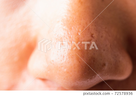 Woman large pores have freckles cheek oily, acne pimple on nose 72578936