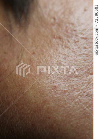 男性臉上的痤瘡疤痕 男性臉上的痤瘡疤痕 72590683