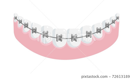 Metal dental braces on straight teeth in jaw gum 72613189