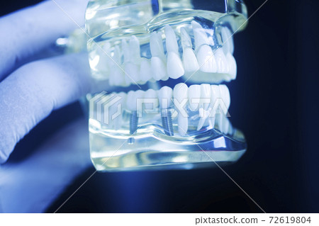 Dental tooth implant model 72619804