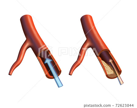 Atherosclerosis 72623844