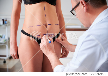 Plastic surgeon drawing lines on young woman body. Plastic surgeon drawing lines on young woman body. 72626959