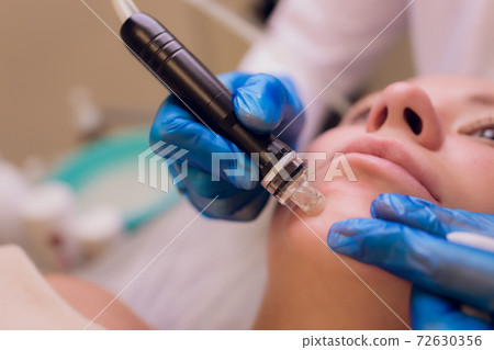 Woman cleaning nose skin pores using vacuum blackhead remover, cosmetic procedure. Woman cleaning nose skin pores using vacuum blackhead remover, cosmetic procedure. 72630356