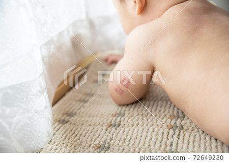 靠窗的手臂上有BCG痕蹟的嬰兒 靠窗的手臂上有BCG痕蹟的嬰兒 72649280