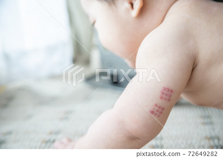 Baby with BCG marks on his arm by the window Baby with BCG marks on his arm by the window 72649282