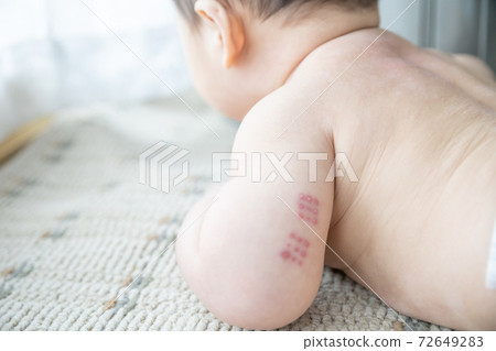 Baby with BCG marks on his arm by the window Baby with BCG marks on his arm by the window 72649283