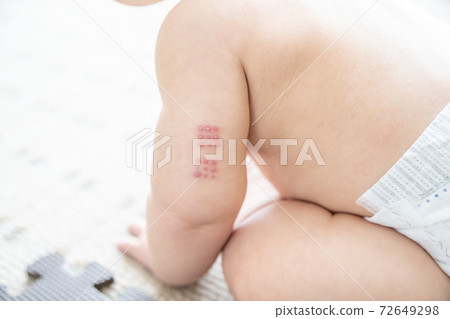 Baby with BCG marks on his arm sitting by the window 72649298