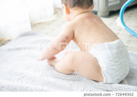Baby with BCG marks on his arm sitting by the window 72649302