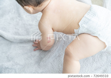 Baby with BCG marks on his arm sitting by the window Baby with BCG marks on his arm sitting by the window 72649310
