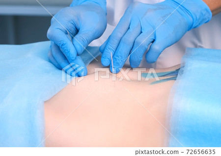 Man doctor acupuncturist in gloves inserts acupuncture needle to woman abdomen. Man doctor acupuncturist in gloves inserts acupuncture needle to woman abdomen. 72656635