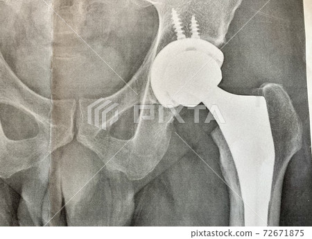人工髖關節 人工髖關節 72671875