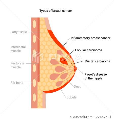 Breast disease concept Breast disease concept 72687691