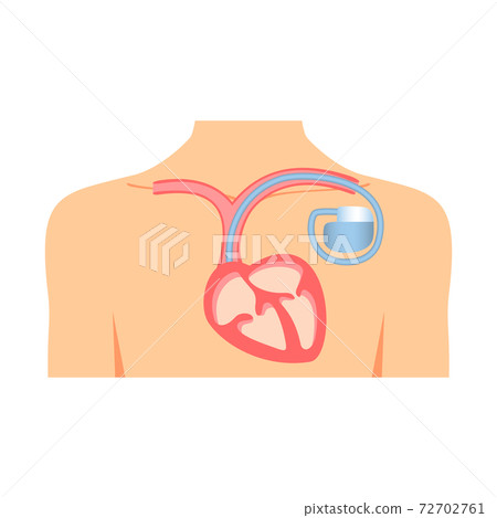 與起搏器的胸部圖 與起搏器的胸部圖 72702761