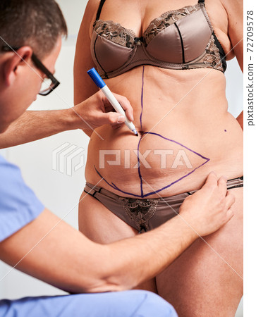 Doctor drawing marks on woman body before plastic surgery. 72709578