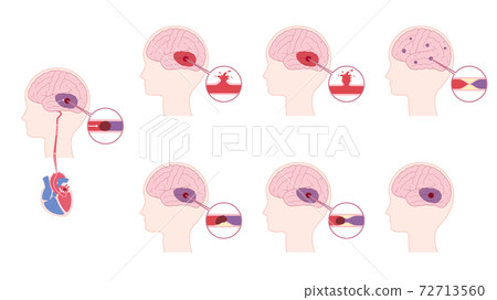 Illustration material set of the cause of stroke_cerebral infarction_cerebral hemorrhage 72713560