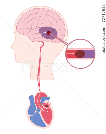 Illustration of cardiogenic cerebral infarction_cerebral embolism 72713638
