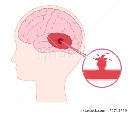 Illustration of ruptured cerebral aneurysm Illustration of ruptured cerebral aneurysm 72713739