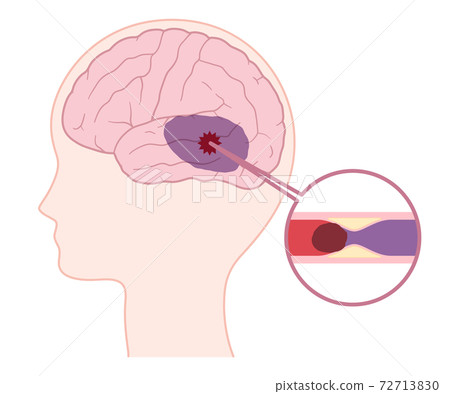 動脈粥樣硬化性腦梗死的插圖 72713830