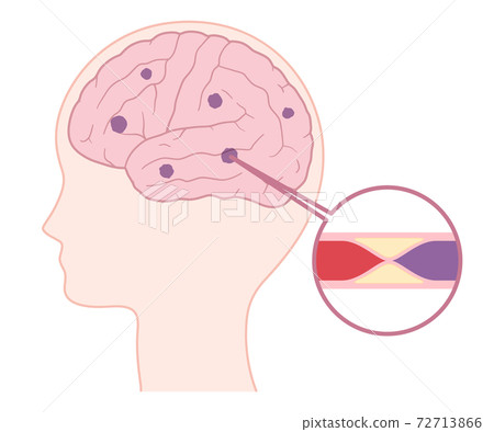 腔隙性梗塞的插圖 腔隙性梗塞的插圖 72713866