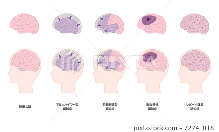Dementia Brain Illustration Material Set_Atrophy_Vascular_Lewy Body 72741018