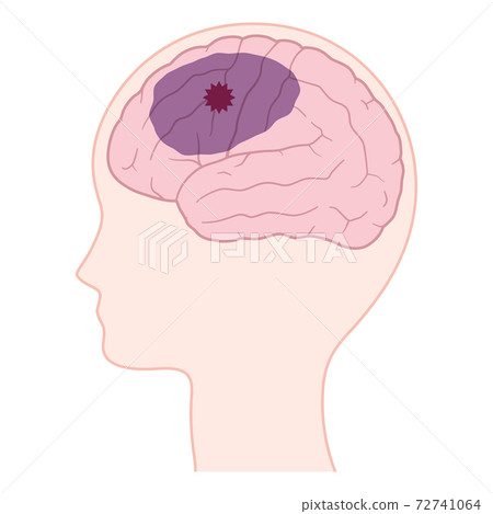 腦血管性癡呆的大腦的插圖 腦血管性癡呆的大腦的插圖 72741064