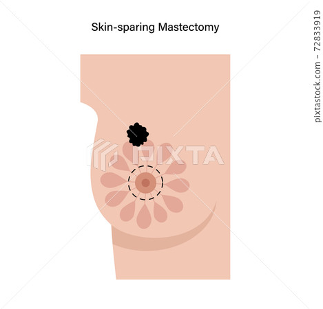 Breast disease concept Breast disease concept 72833919