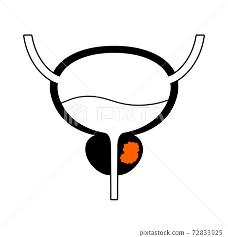 Prostate cancer concept 72833925