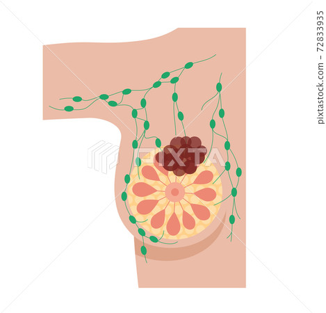 Breast disease concept Breast disease concept 72833935