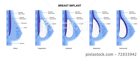 Breast Implant Concept 72833942