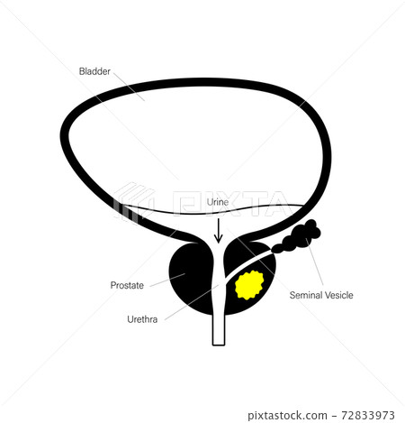 Prostate cancer concept Prostate cancer concept 72833973