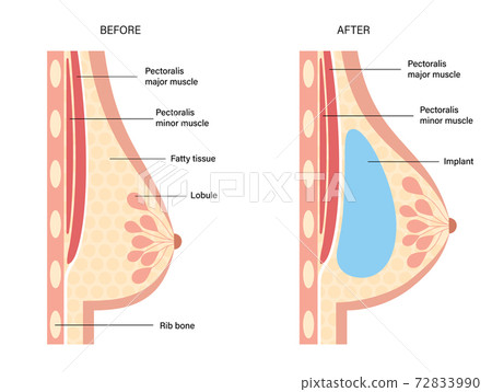 Breast Implant Concept 72833990