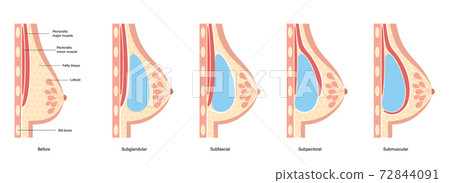 Breast Implant Concept Stock Illustration 72844091 PIXTA