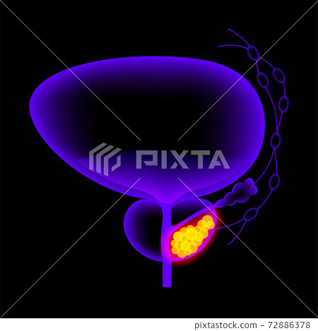 Prostate cancer concept 72886378