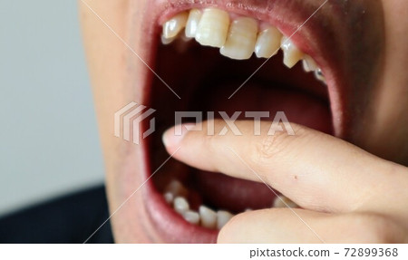 Close-up of a person with tooth decay Close-up of a person with tooth decay 72899368