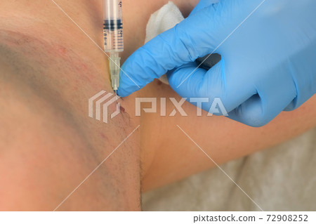 Surgeon gives injection of local anesthesia before laser removing mole. Surgeon gives injection of local anesthesia before laser removing mole. 72908252
