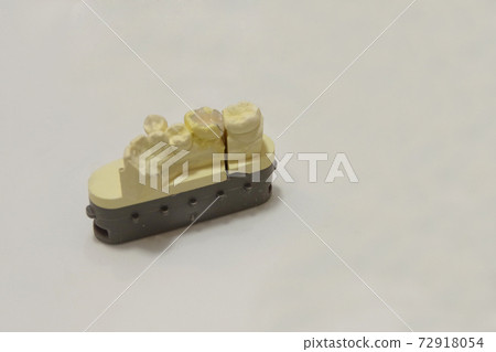 牙齒陶瓷鑲嵌，用於後牙 72918054