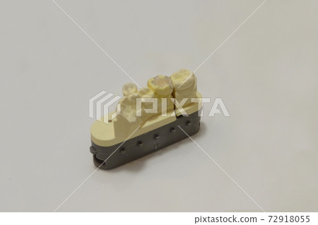 牙齒陶瓷鑲嵌，用於後牙 72918055