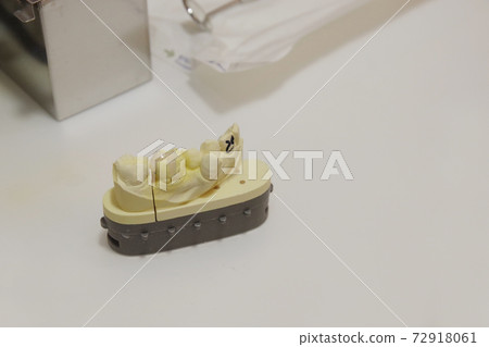 牙齒陶瓷鑲嵌，用於後牙 72918061