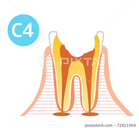 Caries and Progression and Treatment: Dental Illustration 72921569