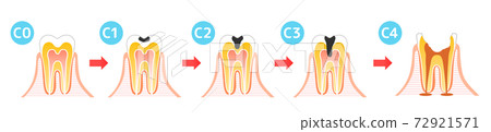 Caries and Progression and Treatment: Dental Illustration 72921571