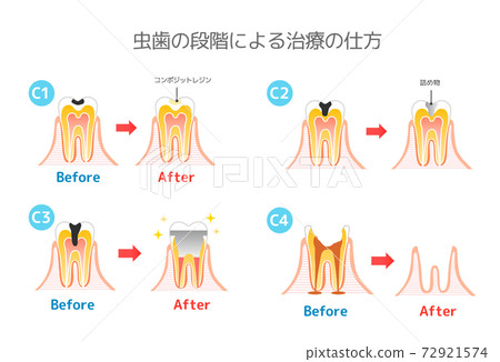 Caries and Progression and Treatment: Dental Illustration 72921574