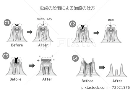 Black and White Printed Caries and Progression and Treatment: Dental Illustrations Black and White Printed Caries and Progression and Treatment: Dental Illustrations 72921576