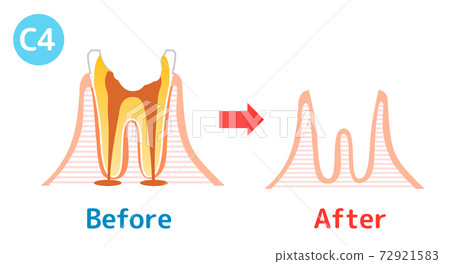 Caries and Progression and Treatment: Dental Illustration 72921583