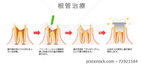 Root Canal Treatment Caries and Progression and Treatment: Dental Illustration 72921584